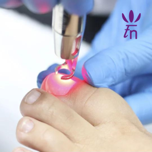 I Sesión Láser Eliminación Onicomicosis